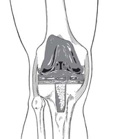 Total knee replacement