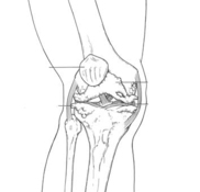 Diseased knee
